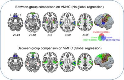 Frequency-Dependent Changes in Interhemispheric Functional Connectivity Measured by Resting-State fMRI in Children With Idiopathic Generalized Epilepsy